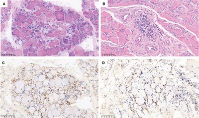 Anti-SRP immune-mediated necrotizing myopathy responsive to ofatumumab: a case report